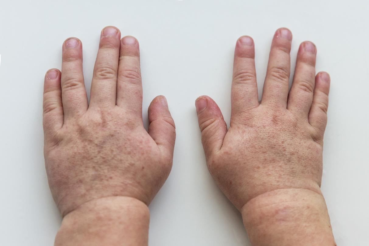 近期高发！2-10岁儿童容易被感染，出现这些症状需警惕